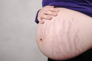 cara menghilangkan stretch mark semasa hamil, ketika mengandung